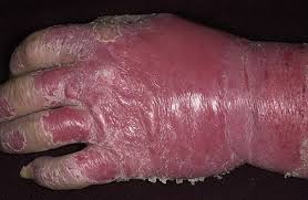 Apariția mâncărime și de arsură a pielii; Psoriazis Poze Psoriazis Imagini