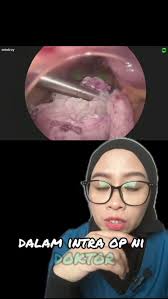 Adenomyosis with huge uterine fibroids