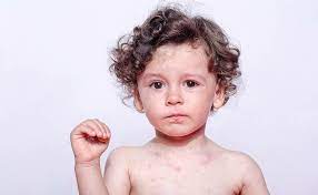 Mi Hijo Tiene Alergia Al Huevo Que Puedo Hacer Eres Mama
