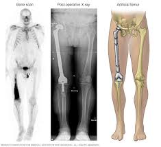 What are the symptoms of bone cancer? Chondrosarcoma Diagnosis And Treatment Mayo Clinic