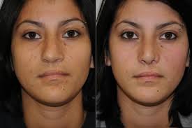 A deviated septum occurs when your nasal septum is significantly displaced to one side, making one nasal air passage smaller than the other. Nose Job Pasadena Revision Rhinoplasty Los Angeles Dr Panossian