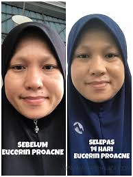 Rawatan supliment minda examakeajaiban supliment minda exama nie berasaskan 3 jenis mineral yang sangat diperlukan oleh otak yang mampu pastikan masalah. Cabaran Bebas Jerawat Selama 14 Hari Bersama Eucerin Proacne Solution Marshalizadotcom