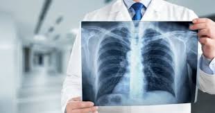 Rippenbruch Rippenfraktur Apomio Gesundheitsblog