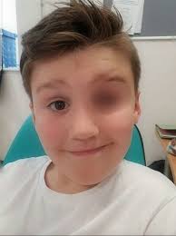 Miris! Bola Mata Anak ini Harus Dikeluarkan Setelah Terkena Peluru Mainan