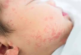 Image result for red rash face