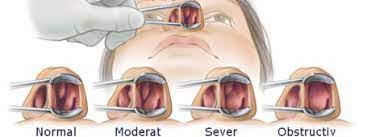 Alergenul este orice particulă care are capacitatea de a declanșa o reacție alergică, care nu este altceva decât o reacție a. Rinita Cronica Hipertrofica Alerta Orl