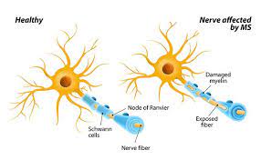 These are usually organic or synthetic keratin fibres which are applied on the scalp and cover your scalp. 7 Things You Don T Know About Multiple Sclerosis Prevention