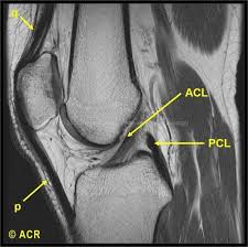 Mri Knee Acl Unidad Especializada En Ortopedia Y Traumatologia En Bogota Colombia Pbx 6923370 Www Unidadortopedia Com Mri Pinterest Radiology And Med