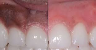 Gum Depigmentation Also Known As Gum Bleaching Is A Procedure Used In Cosmetic Dentistry To Lighten Or Remove Black Spots Or Patc In 2021 Gum Bleaching Dark Gums Gum