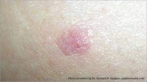 It may be reddish or brown, though sometimes white with flaking skin cells surrounded by a small blotch of darker skin. Dermatologists Offer Tips On How To Prevent And Detect Skin Cancer Penn Today