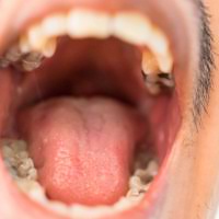 If caught at an early stage, the outlook for the later it's diagnosed, the more likely it is that mouth cancer treatment will involve major the last thing i want to do is to cause unnecessary concern, or to flood my surgery with worries from the one in five. Know Your Mouth To Prevent Oral Cancer Threat World First Travel Insurance