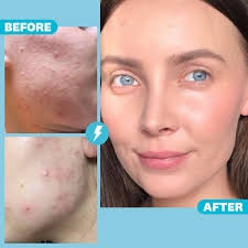 Most acne scars can go away on their own (without use of treatment) some types of acne scars require professional treatments acne scars can take 3 to 24 months to fade acne scar treatments include: Quitting Dairy And Holistic Acne Treatment Helped Clear My Acne