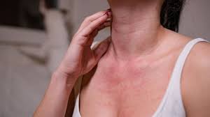 Image result for Anaphylaxis