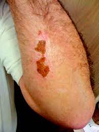 Wound desiccation and eschar formation interfere with the healing process and should be prevented if possible. Eschar Definition Of Eschar By Medical Dictionary