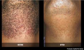 Prp (platelet rich plasma) gives your skin that glow, texture, tone and young look you always wanted. Facial Laser Hair Removal In Weston Fl Weston Med Spa