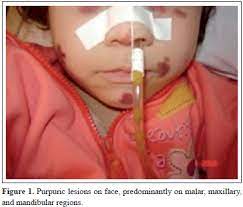 Also known as senile purpura,12 solar purpura,13 traumatic purpura, and bateman's disease,14 it is characterized by unsightly ecchymoses and purple patches on the arms or legs of elderly persons caused by blood extravasation following minor trauma. Unusual Face Involvement In Henoch Schonlein Purpura