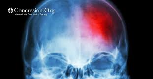 A violent collision or shock. Do You Have A Concussion Concussion Org