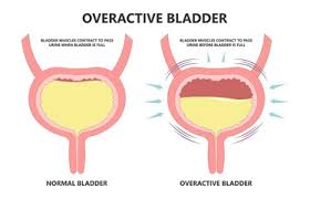 Image result for Overflow Incontinence