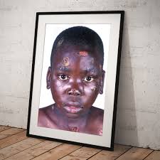 Aids Boy With Impetigo Art Print by Science Photo Library