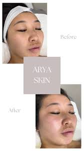 ✨8D HiFU models needed at our clinic for content purposes!✨ Cost: Full face  RRP $1100 NOW $260 Full face + neck RRP $1600 NOW $390 Neck RRP $990 NOW  $190 Full abdomen