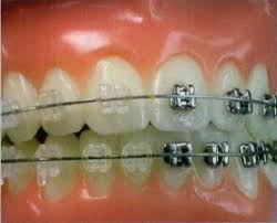 Image result for zubní kanyla