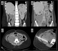 Image result for Perinephric Abscess