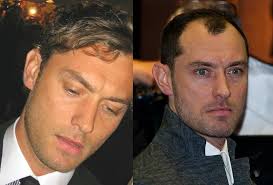 That is key and that makes a lot of differen. Video Celebrity Hair Transplants Dr U S Clinic In Manhattan Beach Los Angeles