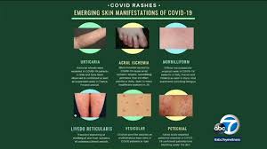 'covid toes' and 'kawasaki' rash: Coronavirus Los Angeles Dermatology Organization Issues Guidance On Skin Rashes Associated With Coronavirus Abc7 New York