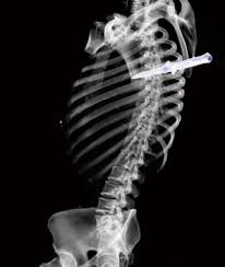 Image result for Chest Trauma