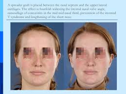 Correcting faulty nasal valves has the potential to improve nasal obstruction, which in turn improves nasal breathing. Grafts In Nasal Surgery V1