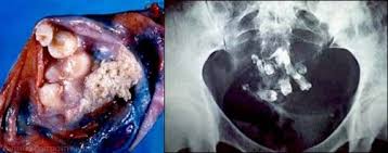 Teratoma A Germ Cell Tumor With Tissue Resembling Normal Organs Pictured Is An Ovarian Teratoma With Teeth Ovarian Teratoma Tumor Dermoid Cyst
