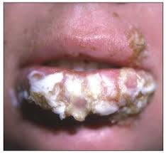 Early redness of the skin. Herpes Simplex Initial And Recurrent Infections