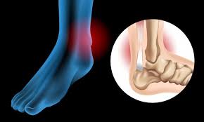 Knee diagram tendons, download this wallpaper for free in hd resolution. Premium Vector Diagram Showing Chronic Achilles Tendon Tear