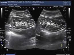 Ultrasound Video Showing Bilateral Renal Microlithiasis Youtube