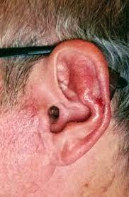 Since bccs often crop up on parts of the body where skin is thin, lesions on the scalp, ears, nose and other areas of the face may be best treated by mohs. Mohs Surgery On My Ear Warning Photos Below Show An Open By John Records Medium