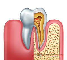 If you're experiencing slight discomfort after your procedure, don't worry, it's normal for this to persist for a few days. Root Canal Treatment Restorative Dental Care Castle Family Dentistry