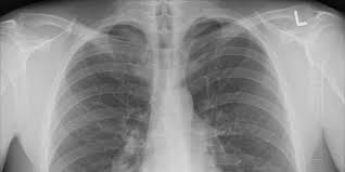 L'embolia polmonare (ep) è l'ostruzione acuta (completa o parziale) di uno o più rami dell'arteria polmonare, da parte di materiale embolico proveniente dalla circolazione venosa sistemica. Francesca Giacomazzi Cardiologo E Internista A Milano