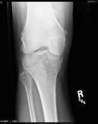 Learn about this soft tissue calcification around the knee joint. Medpix Case Pellegrini Stieda Lesion