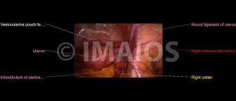 8:35 anatomy of the pelvic 10:40 vaginal support and uterosacral ligaments. Surgical Anatomy Of The Female Pelvis By Laparoscopy