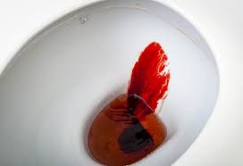 Image result for Blood in stool
