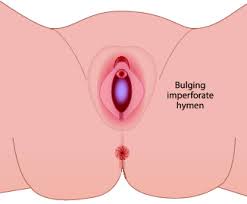 The hymen can broken in a variety of ways and is not a marker of virginity. F12 Labial Adhesions And Imperforate Hymen Springerlink