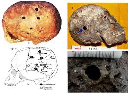 Address search in world cities. 1 A Multiple Trepanations On Burzahom Female Skull At Ansi Kolkata Download Scientific Diagram