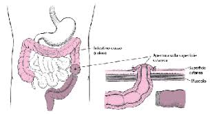 Consigli alimentari in caso di diverticolite. Diverticolite Disturbi Digestivi Manuale Msd Versione Per I Pazienti