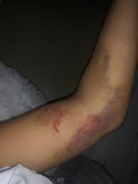 It no longer wakes me up at night (it did for months). Hematoma From A Blood Draw Medicalgore