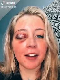 Check spelling or type a new query. Woman S Eyelid Bitten Off By Chihuahua During Worst Lash Appointment Nz Herald