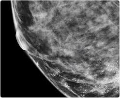But radiologists can still see signs of cancer. Microcalcifications In Breast Cancer
