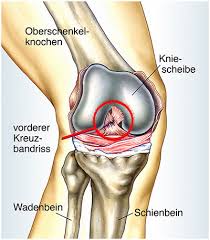 Vorderer Kreuzbandriss Ursachen Symptome Behandlung Medlexi De