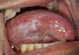 Oral cancer can appear anywhere in the mouth, including the inside of the cheeks and the gums. Self Oral Cancer Screening Socs Education Program School Of Dentistry Lsu Health New Orleans