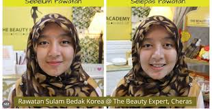 Tidak sihat untuk mengalami parut, terutamanya jika di muka. Pengalaman Mencuba Rawatan Sulam Bedak Korea Nurulzayani Com