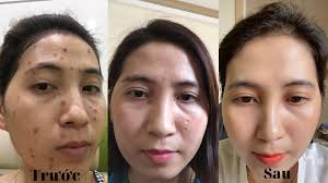 Scar Esthetique-Kem Giảm Sẹo Thâm, Sẹo Rỗ, Lõm Rejuvaskin